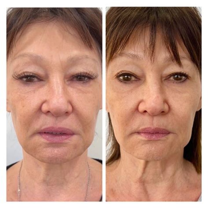 Susan Page Makeover- Plastic Surgery Before And After Photos